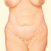 Tummy Tuck, Outline