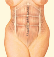 Tummy Tuck, Interior Incision