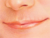 Nasolabial Folds, Before