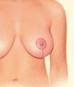 Breast Lift, Incision